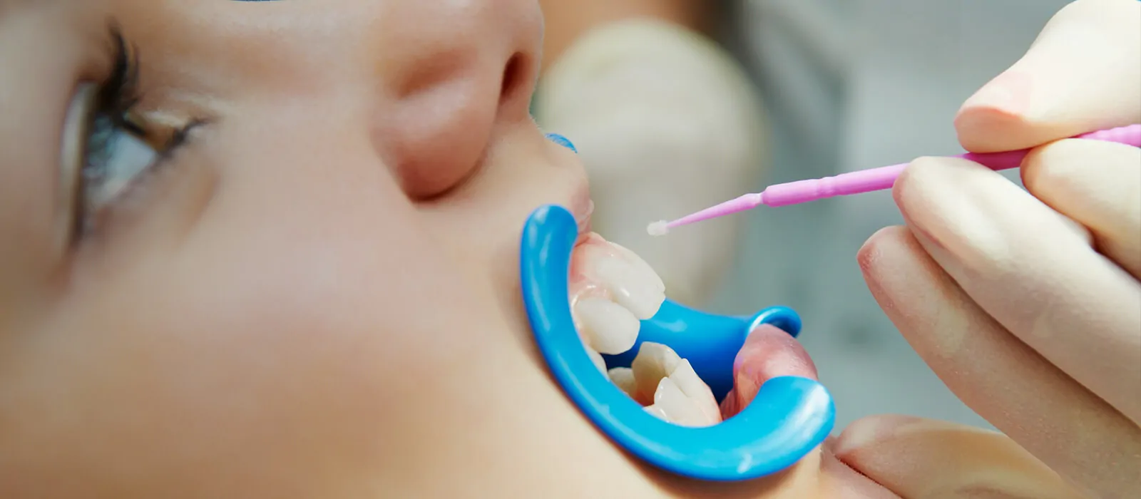 pd-banner-fluoride-treatments