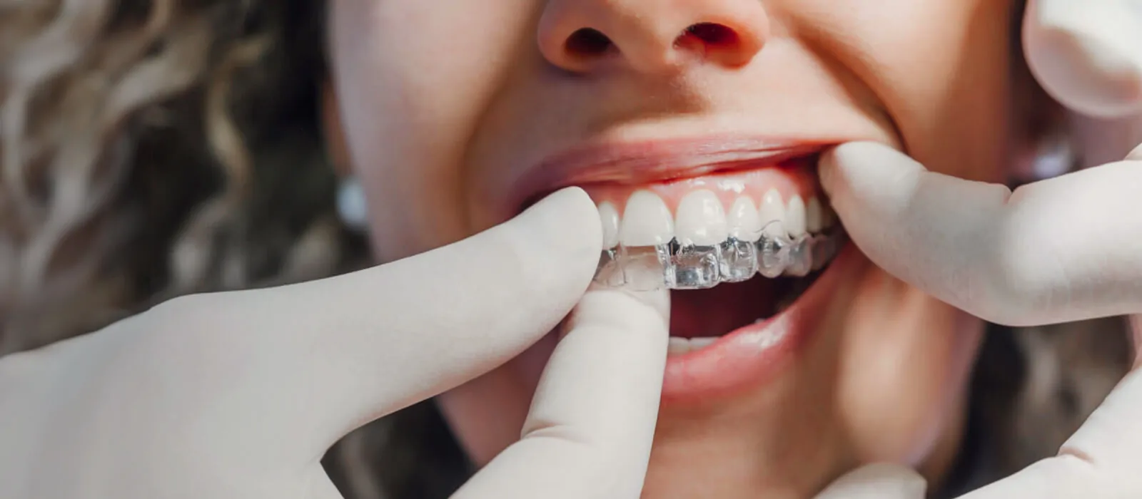 pd-banner-invisalign