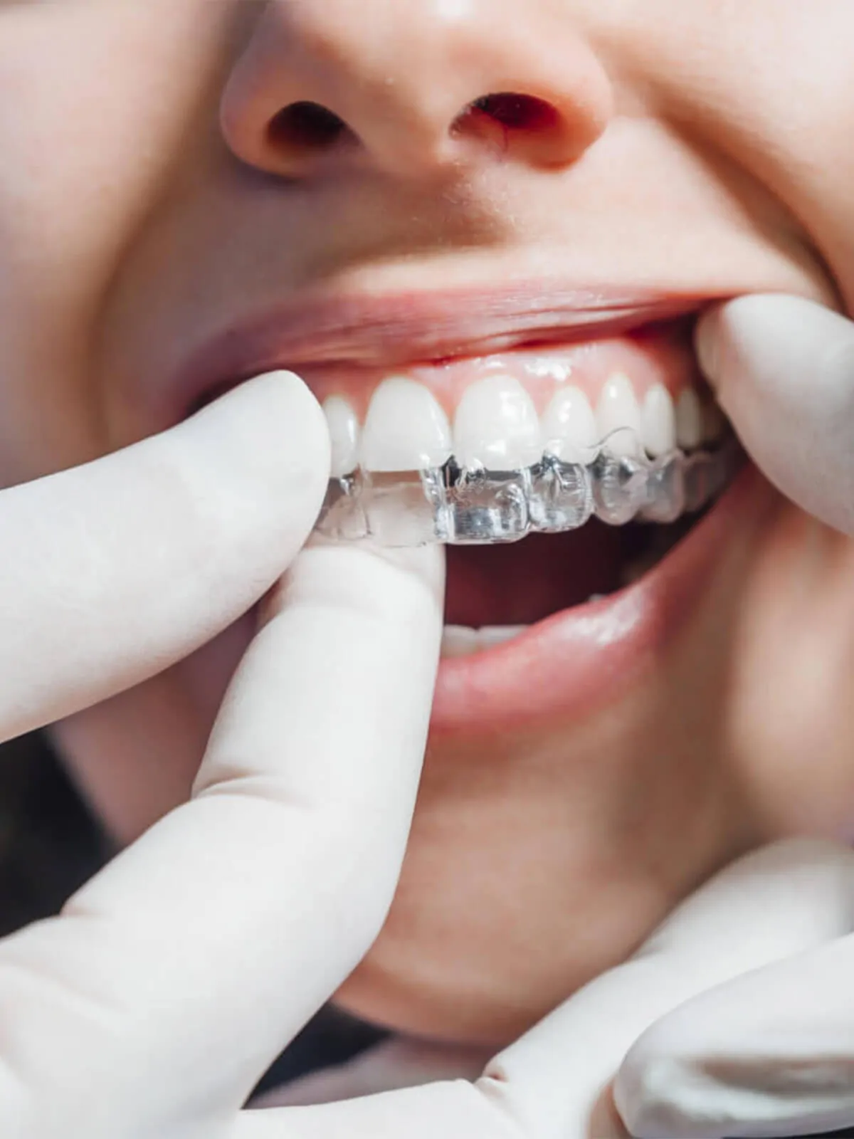 pd-gallery-invisalign